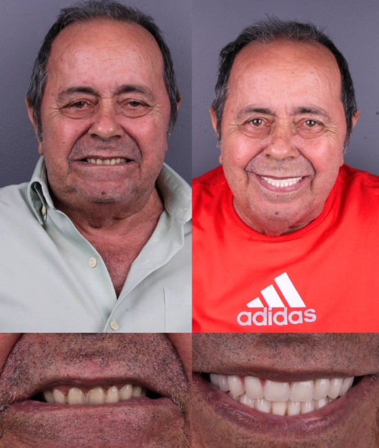 ft-antes-e-depois-1-OK-1.webp