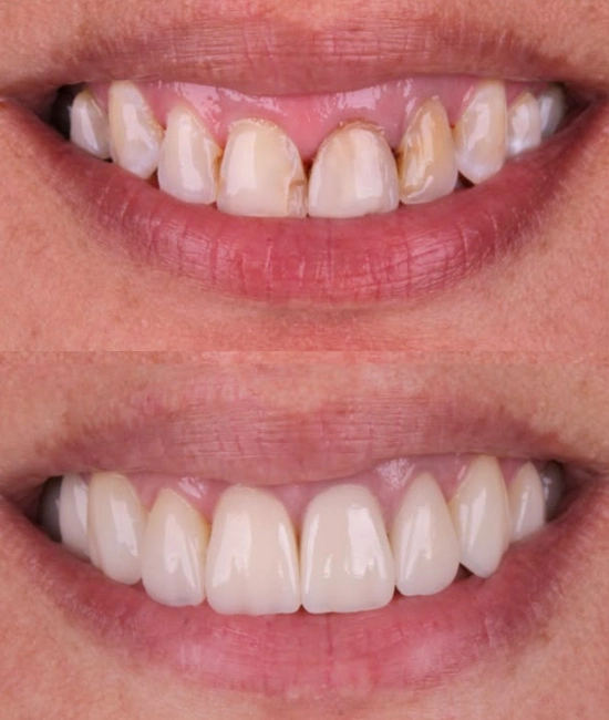 ft-antes-e-depois-10-OK-1.webp