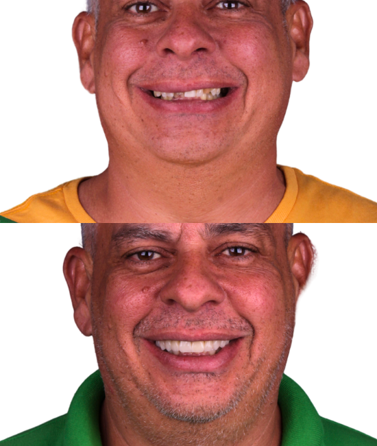 ft-antes-e-depois-12-OK.png