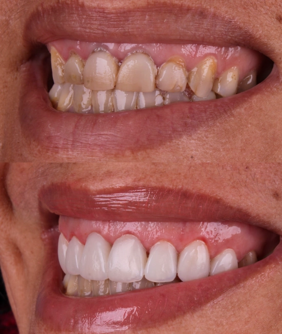 ft-antes-e-depois-2-OK.webp