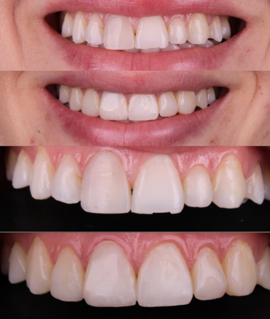 ft-antes-e-depois-6-OK.webp