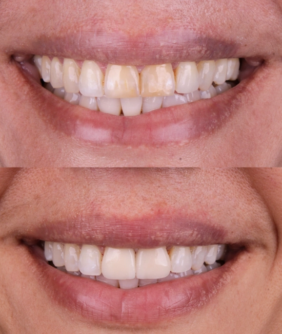 ft-antes-e-depois-9-OK.webp